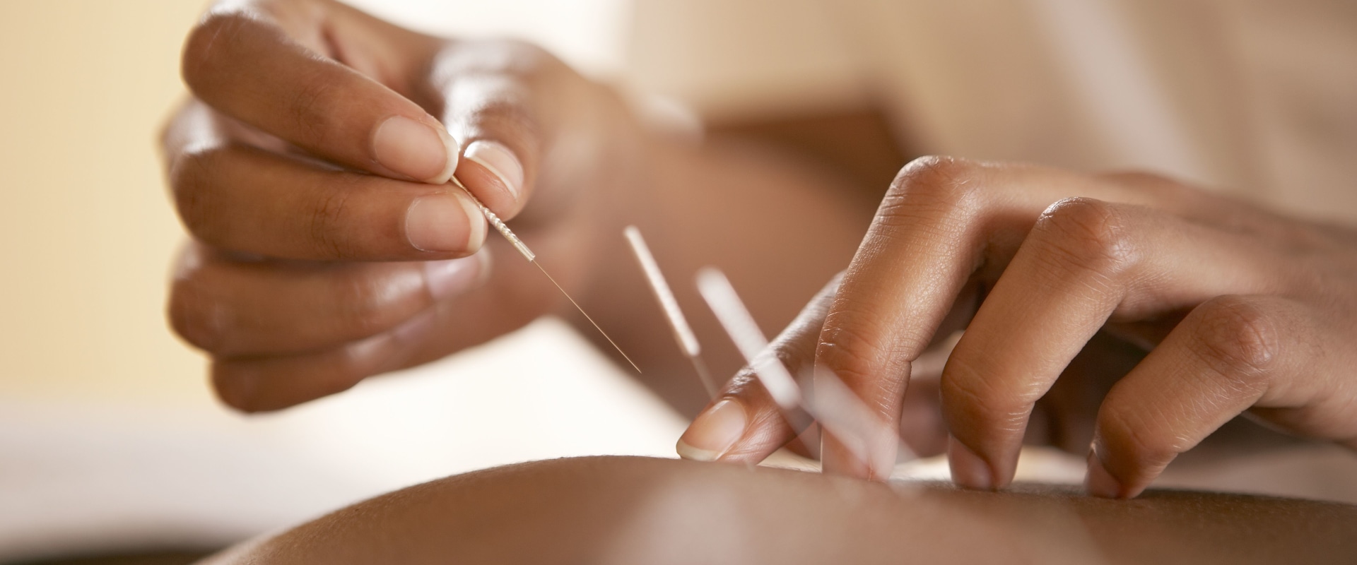 The Benefits of Acupuncture for Weight Loss